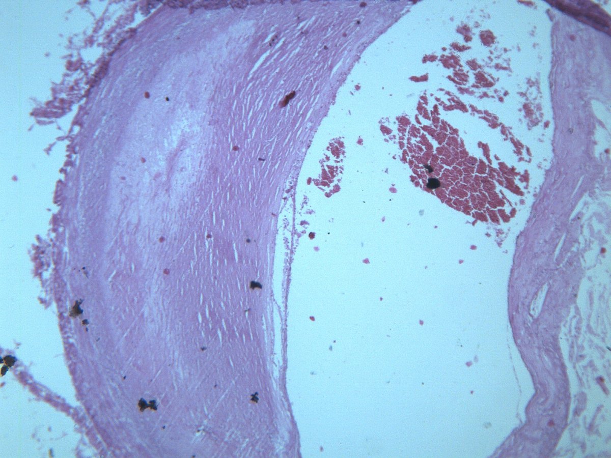 动脉粥样硬化显微图片