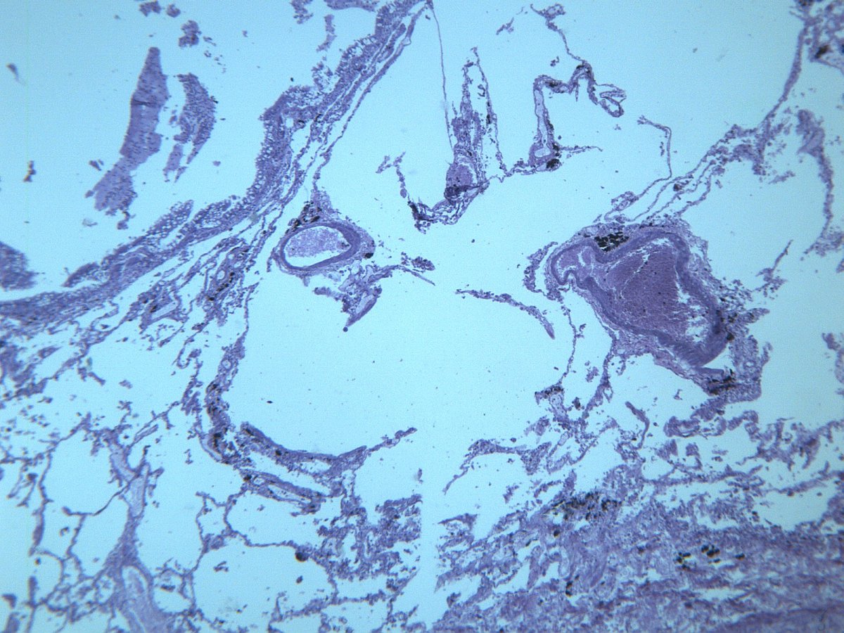 慢性支气管炎显微图片