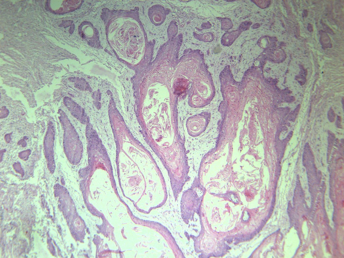 皮肤鳞状细胞癌切片图片
